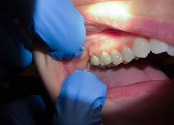 Best Emergency Root Canal Treatment in Churchville, PA